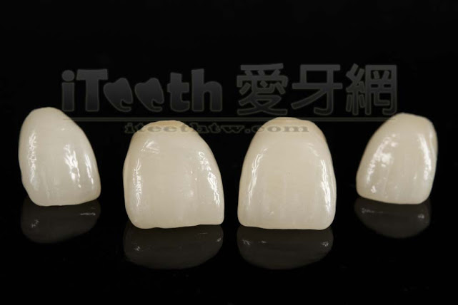 全瓷冠牙套