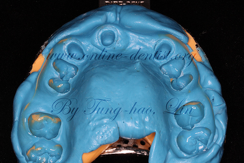 精確印模