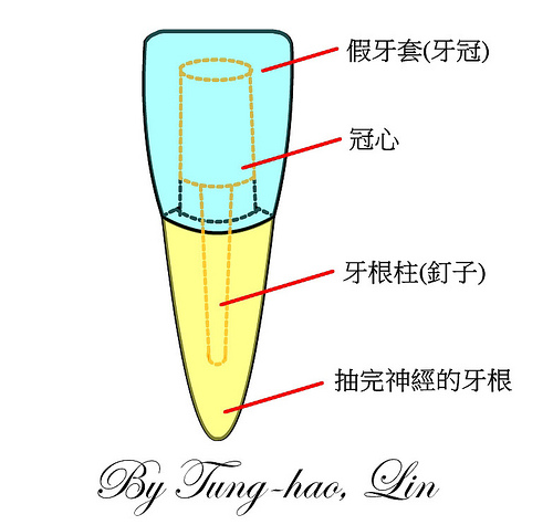 根管治療